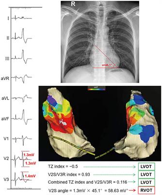 A novel and effective ECG method to differentiate right from left ventricular outflow tract arrhythmias: Angle-corrected V2S